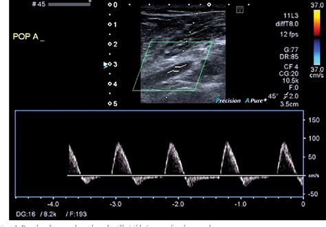 Figure From Ultrasound Guided Percutaneous Aspiration Of Adventitial