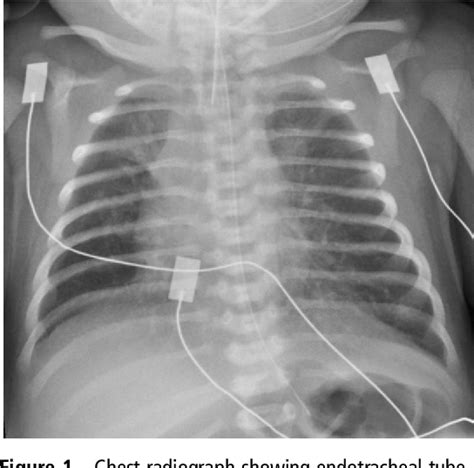 Figure 1 From Incidental Diagnosis Of An H Type Tracheo Oesophageal