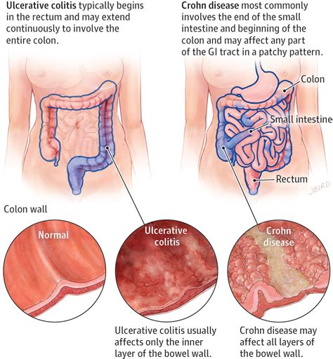 Inflammatory Bowel Disease Gastroenterology Jama Jama Network