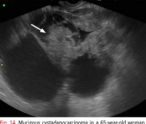 Figure 2 From Ultrasonography Of Ovarian Masses Using A Pattern