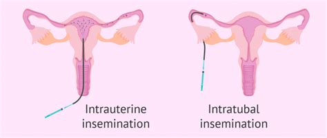 What Are Antisperm Antibodies? - Causes & Treatment