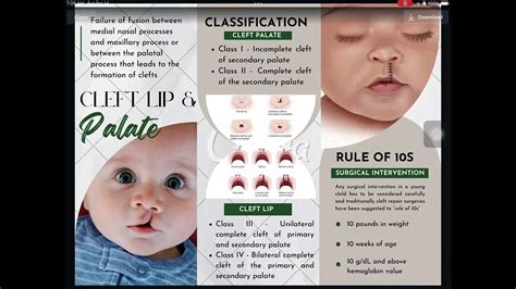 E2 Clitar Macariola Interdisciplinary Treatment On Cleft Lip And Palate Patients Youtube