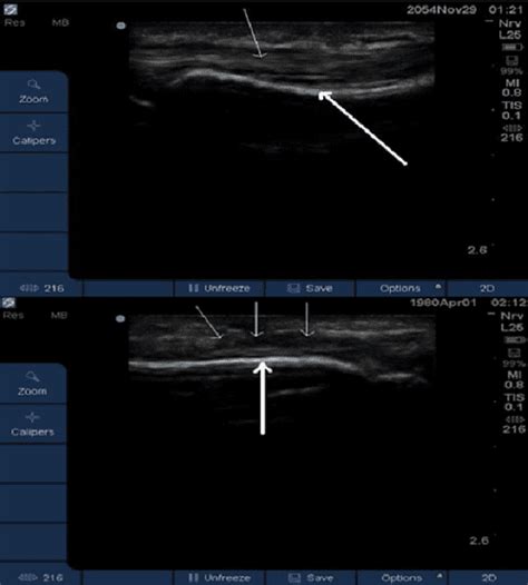 Ultrasound Scanning In The Post Operative Assessment Of Flexor Tendon