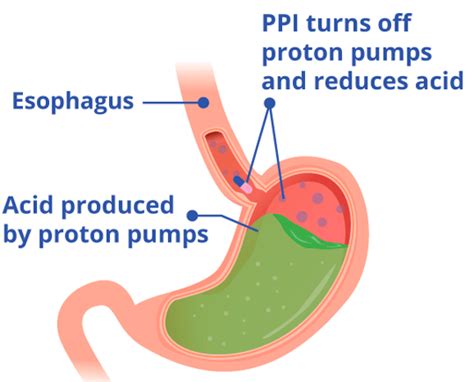 Proton Pump Inhibitors For Gastric Symptoms Healthtips By TeleMe