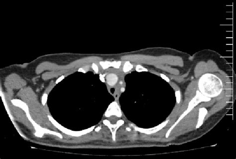 Chest Ct Scan Of The Patient With Arterial Phase Showing The Aneurysmal