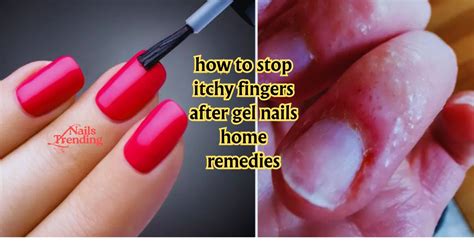 how to stop itchy fingers after gel nails home remedies