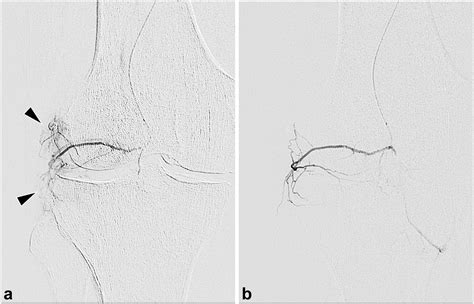 Genicular Artery Embolization For Treatment Of Symptomatic Knee