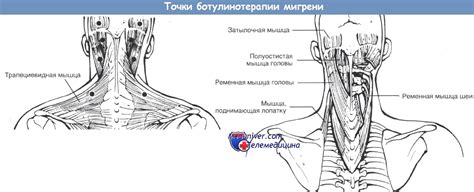 Схема ботулинотерапии мигрени (лечение ботулотоксином)