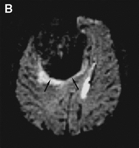 Perfusion Mr Imaging Basic Principles And Clinical Applications