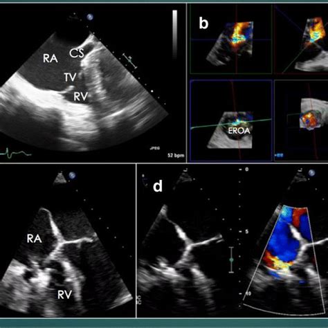 Mitraclip Imaging A Transseptal Puncture For MitraClip Biplane TEE