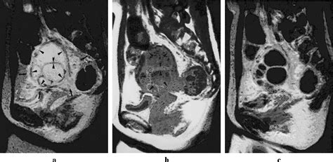 Figure 1 from Adnexal masses caused by pelvic inflammatory disease: MR ...