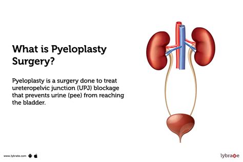 Pyeloplasty Surgery: Purpose, Procedure, and Benefits and Side Effects