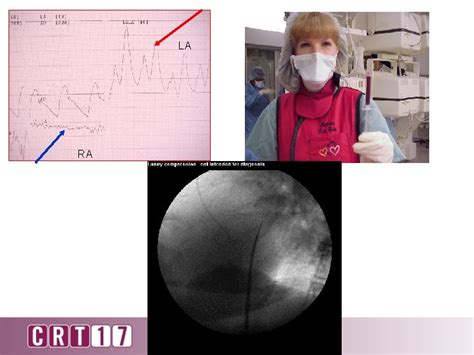 How To Perform A Successful Transseptal Puncture Zoltan