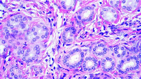 Pathology Outlines Bile Duct Adenoma