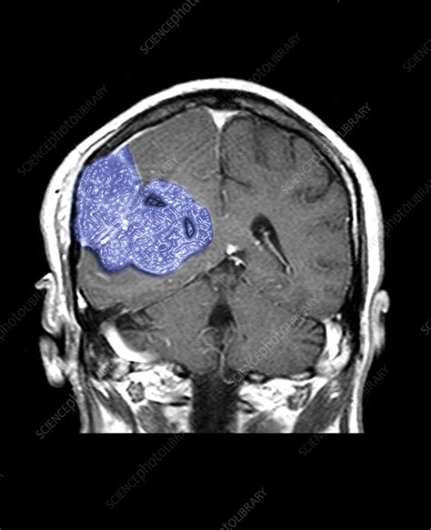 Brain Mri Tumor