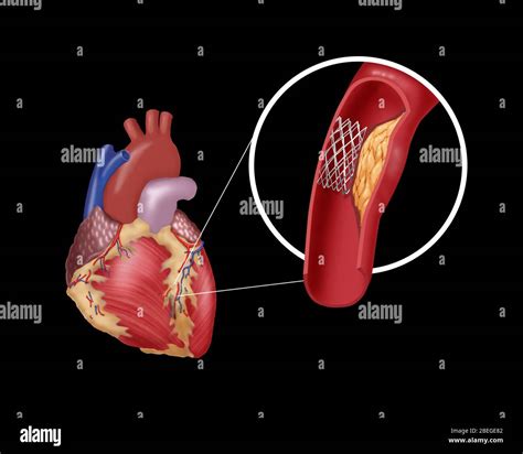 Angioplastia Coronaria Fotos E Imágenes De Stock Alamy