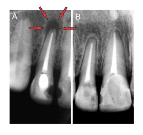 Periapical Granuloma Radiograph