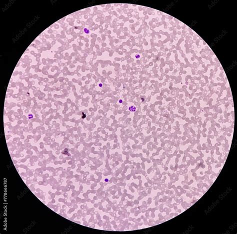 A peripheral blood smear, hypersegmented neutrophil was seen. Greater then 6 lobes in ...