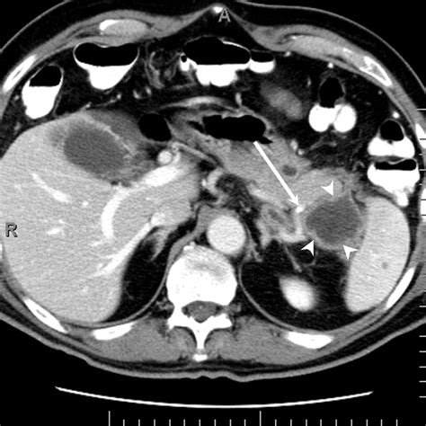 Pancreas Peritoneal Reflections Ligamentous Connections And Pathways