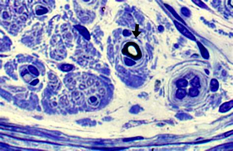 Chronic Demyelination