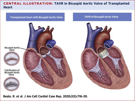 transcatheter aortic valve replacement   bicuspid aortic valve
