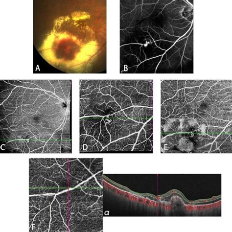 Multimodal Imaging In Patient 9 A Fundus Photography Before Treatment