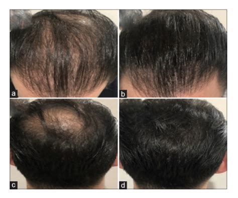 Dr Donovan S Hair Loss Articles 2011 2022 — Donovan Hair Clinic