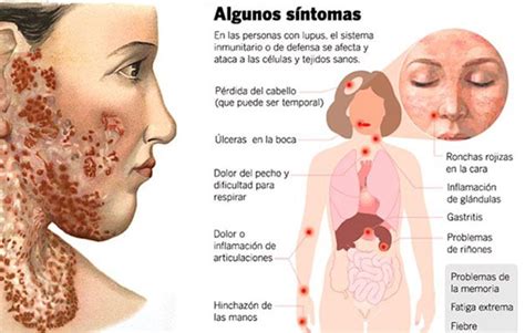 Lupus Eritematoso Sist Mico Causas S Ntomas Y Tratamiento