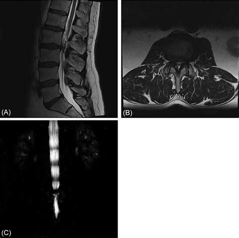 Lumbosacral Spine MRI | Radiology Key