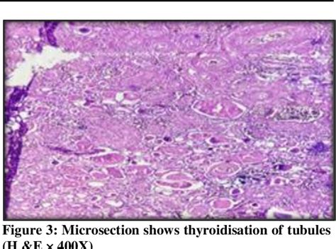 Figure From Histopathological Spectrum Of Kidney Lesions In Autopsy