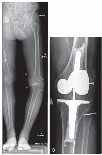 Distal Femoral Replacement | Musculoskeletal Key