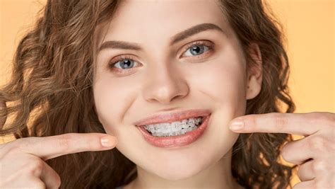 Ceramic Braces Vs Metal Braces Which One Is Better