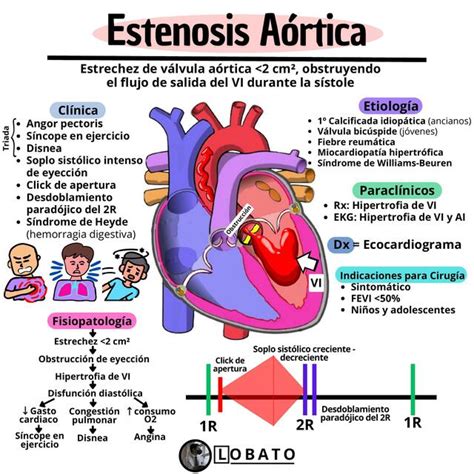 Estenosis A Rtica Resumen Cl Nica Etiolog A Diagn Stico