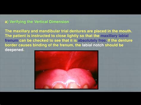 Ppt Try In Of Complete Denture Powerpoint Presentation Free Download Id9638087