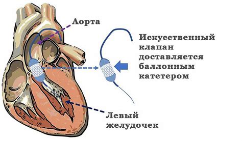 Кардиохирургия в Германии Аортальный клапан строение заболевания методы лечения