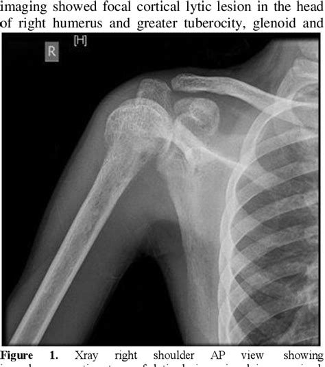 Figure 1 From Osteolytic Bone Lesions A Rare Presentation Of Aml M6