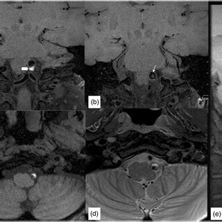 A Year Old Man With A Dissecting Aneurysm At The Right Vertebral