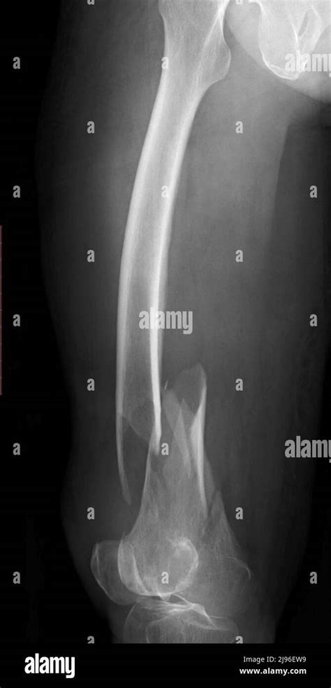 Comminuted Femur Fracture X Ray Stock Photo Alamy