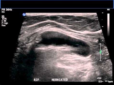 Supraumbilical Hernia Ultrasound