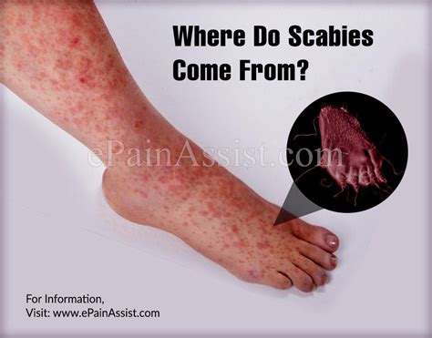 What Does Scabies Look Like On Face What Does