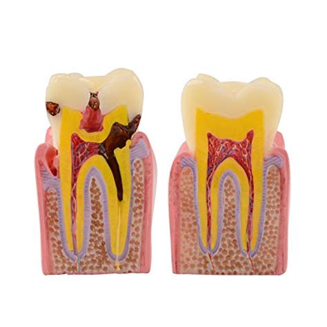 Ultrassist Dental Tooth Decay Model Times Dental Caries Teeth Model