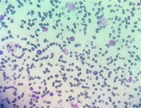 Acute Myeloid Leukemia Mimicking As Acute Megakaryoblastic Leukemia