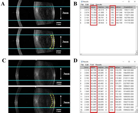 Objective Quantification Of Lens Opacity In Posterior Subcapsular Cataracts Using Iol Master 700