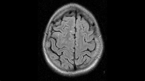 Ms Brain Mri With Contrast