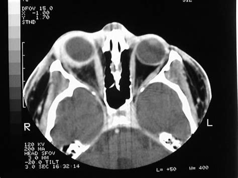 orbital pseudotumor