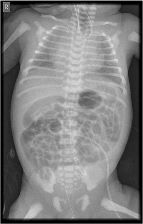 Tracheoesophageal Fistula Radiology