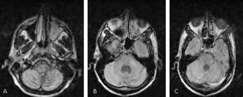 Importancia diagnóstica de leucoencefalopatía multifocal progresiva