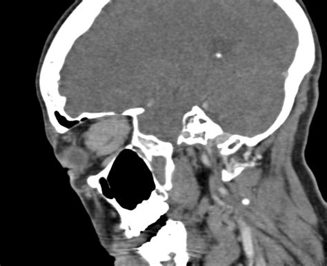 Optic Nerve Meningioma Image