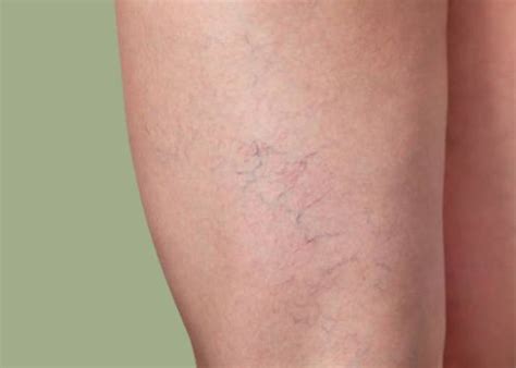 Skin Condition Veins And Dilated Capillaries Skindevour