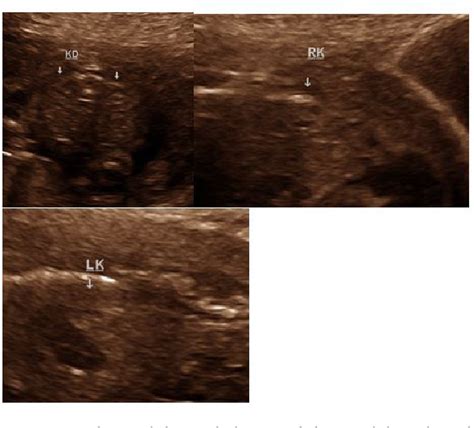 Figure 1 from Prenatal Diagnosis of Denys-Drash Syndrome | Semantic Scholar